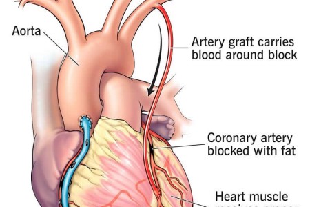 Coronary Artery Bypass Graft