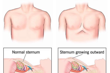 Pectus Carinatum