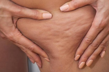 Cellulite
