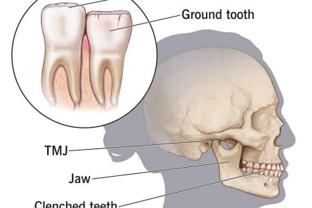 Bruxism (Teeth Grinding)