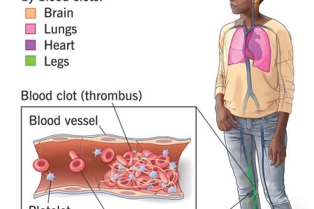 Antiphospholipid Syndrome