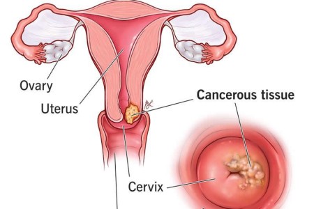 Cervical Cancer