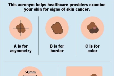 ABCDEs of Skin Cancer