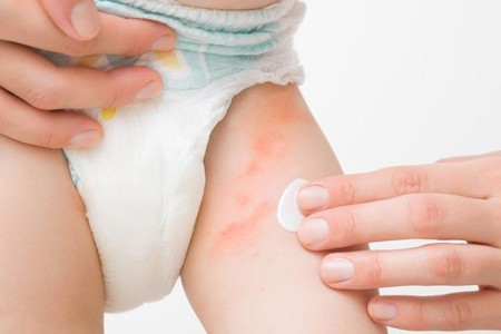 Yeast Diaper Rash