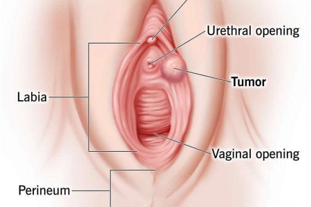 Vulvar Cancer