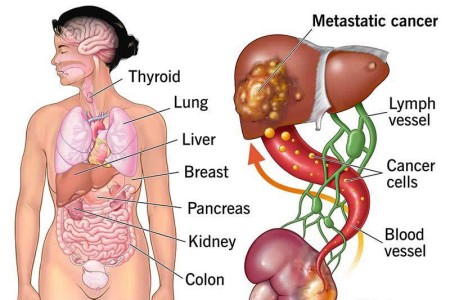 Metastasis (Metastatic Cancer)