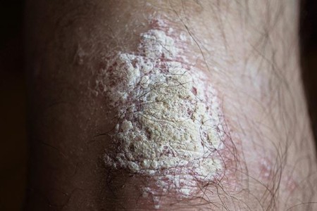 Plaque Psoriasis