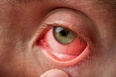Pink Eye (Conjunctivitis)