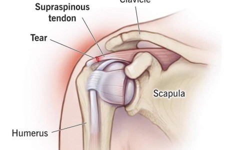 Rotator Cuff Tear