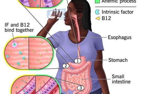Pernicious Anemia