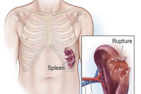 Ruptured Spleen