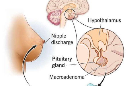 Galactorrhea