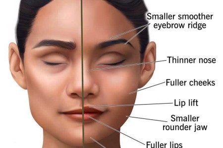 Facial Feminization Surgery