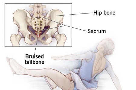 Tailbone Pain (Coccydynia)