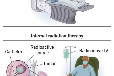 Radiation Therapy