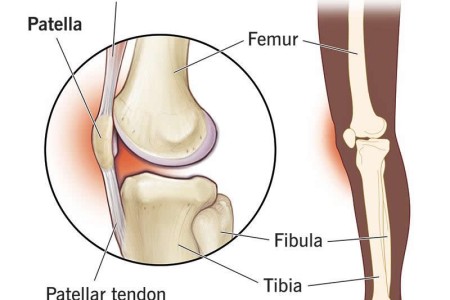 Patellofemoral Pain Syndrome (PFPS)