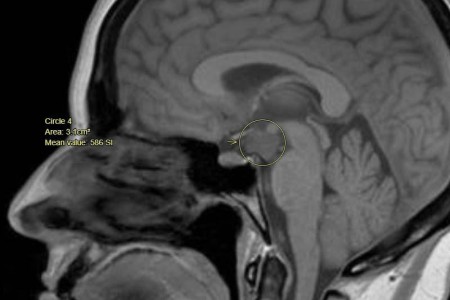 Hypothalamic Hamartoma