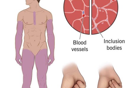Inclusion Body Myositis
