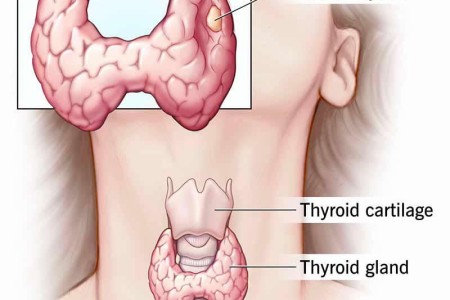 Medullary Thyroid Cancer
