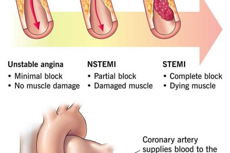 Acute Coronary Syndrome