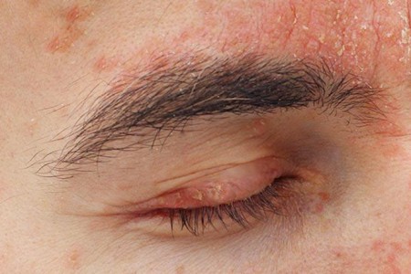 Psoriasis on the Eyelids