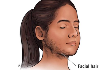 Hirsutism