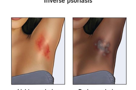 Inverse Psoriasis