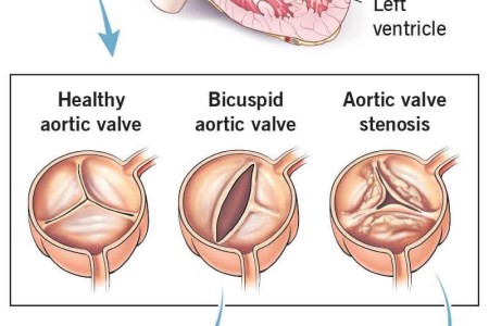Aortic Valve Surgery