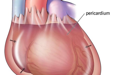 Cardiac Tamponade