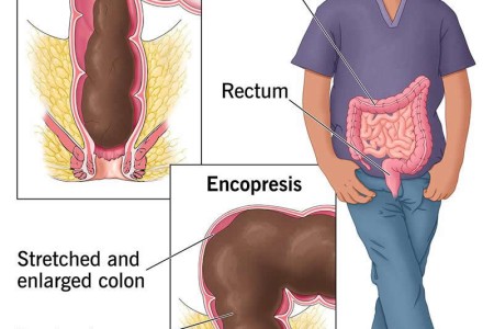 Encopresis (Soiling)
