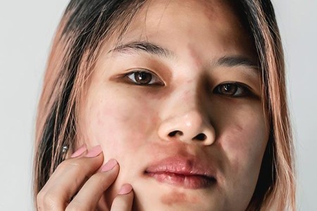Eczema on the Lips (Eczematous Cheilitis)