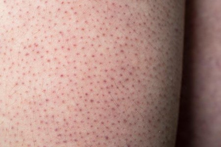 Keratosis Pilaris