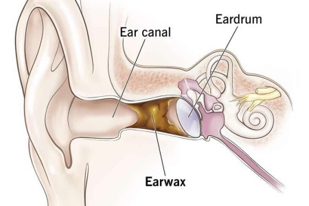Earwax Blockage