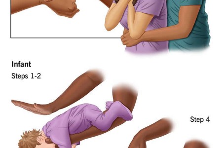 Heimlich Maneuver