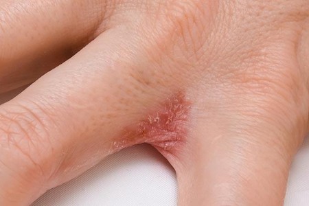 Dyshidrotic Eczema (Dyshidrosis)