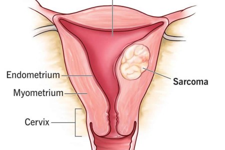 Uterine Sarcoma