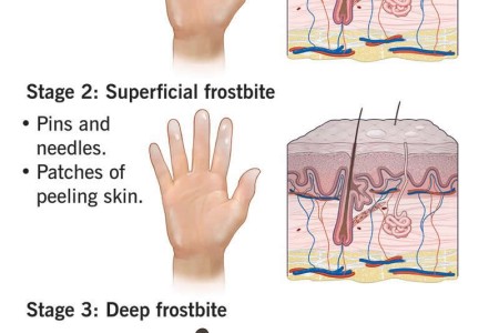 Frostbite