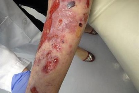 Bullous Pemphigoid