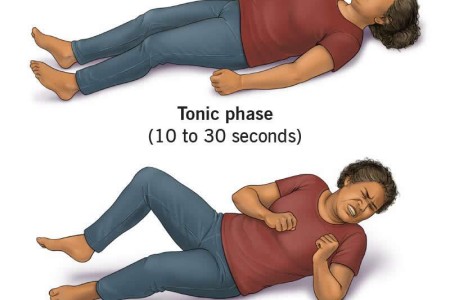 Tonic-Clonic (Grand Mal) Seizure