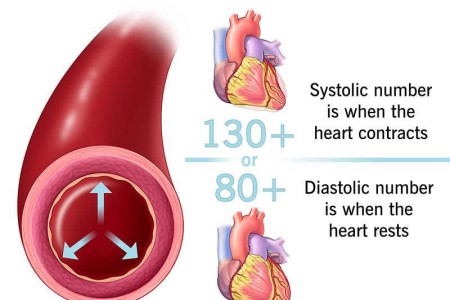 Hypertension (High Blood Pressure)