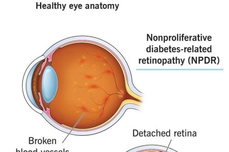 Diabetes-Related Retinopathy