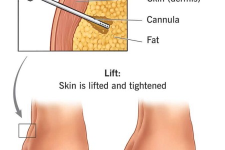 Butt (Buttocks) Lift