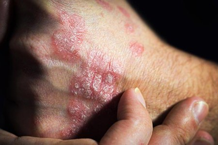 Psoriasis on the Hands and Feet (Palmoplantar Psoriasis)