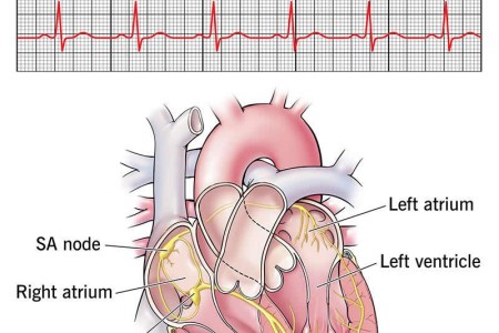 Arrhythmia