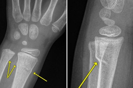 Buckle Fracture (Impacted Fracture)