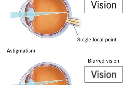 Astigmatism