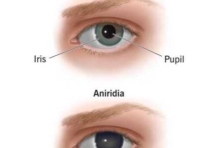 Aniridia (Absence of Iris)