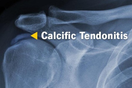 Calcific Tendonitis