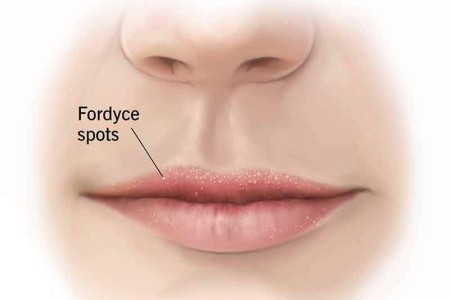 Fordyce Spots
