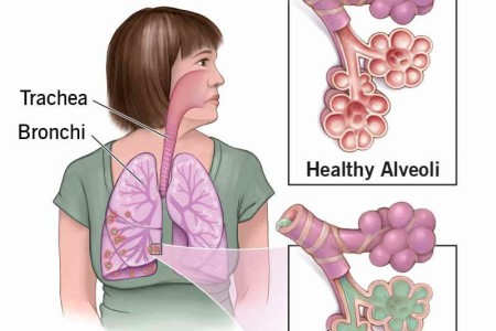 Aspiration Pneumonia
